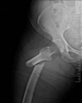 Femur fractures linked to osteoporosis medications | Fosamax | Boniva | Actonel | Reclast | Aredia | Zometa