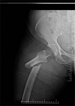 Picture of an atypical femur fracture caused by Boniva